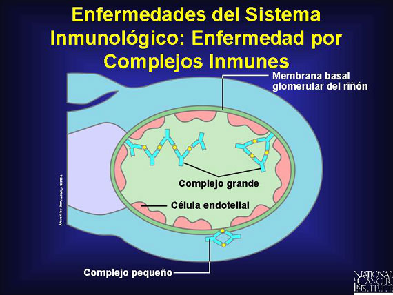 Enfermedades del Sistema Inmunológico: Enfermedad por Complejos Inmunes