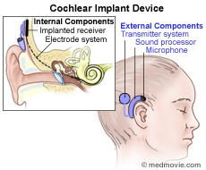 Drawing of cochlear implant device