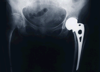 [x-ray showing artificial left hip contrasted with bones of normal right hip]