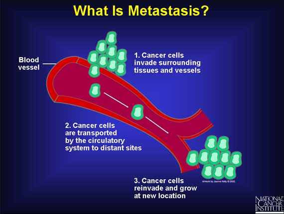 What Is Metastasis?