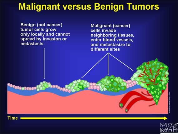 Malignant versus Benign Tumors