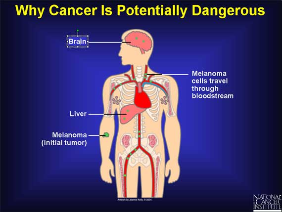 Malignant Versus Benign Tumors