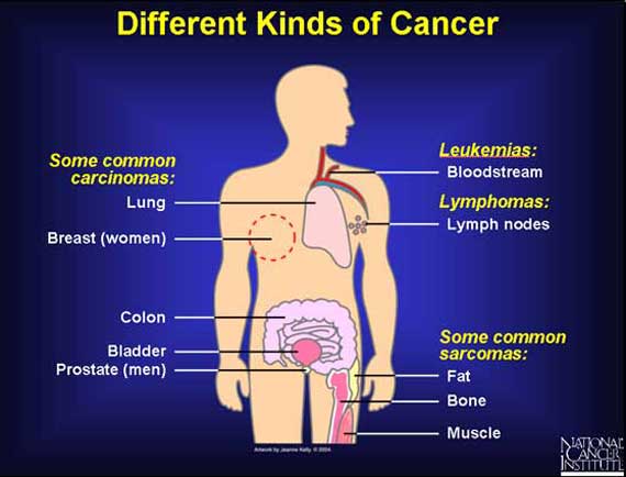 Different Kinds of Cancer