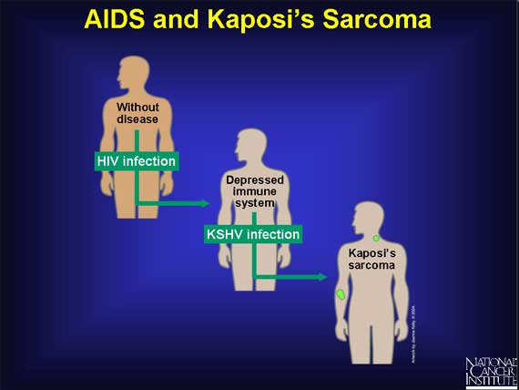 AIDS and Kaposi's Sarcoma