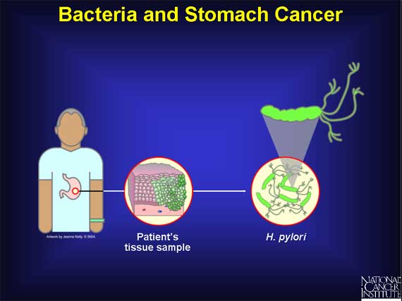 Bacteria and Stomach Cancer
