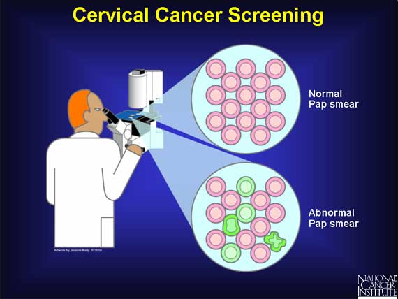 Cervical Cancer Screening