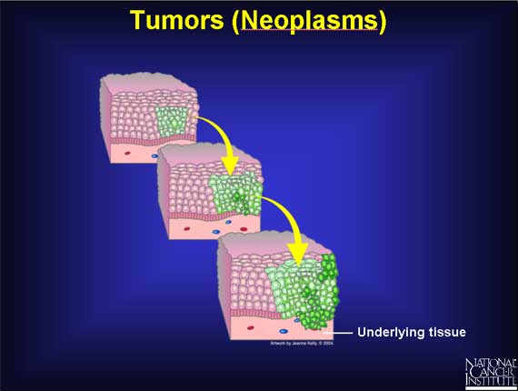Tumors (Neoplasms)