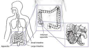 diagram showing the appendix, small intestine, and large intestine, with a detail of an inflamed appendix