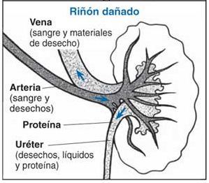 Imagen mostrando un riñón dañado que esta goteando proteína