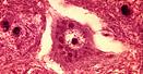 This mircrograph depicts the effect of rabies on brain tissue