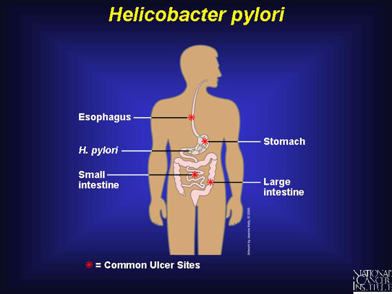 <em>Helicobacter pylori</em>