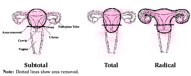 Types of Hysterectomy: Total (removal of uterus including cervix, with ovaries left intact), Subtotal (removal of uterus above cervix, with ovaries left intact), and Radical (complete removal of uterus, cervix, and ovaries).  Dotted lines show how much of the uterus is removed in each type.
