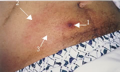 Image: classic erythema migrans. Photograph used with permission from the Journal of Infectious Diseases.