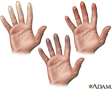 Illustration of fingers showing characteristics of Raynaud's phenomenon