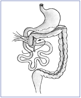 In malrotation, the cecum is not positioned correctly.  The tissue that normally holds it in place may cross over and block part of the small bowel.