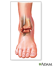 Illustration of a swollen and discolored ankle