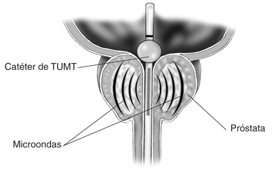 Imagen enseñando parte de la próstata que es calentada por microondas mediante el procedimiento conocido como  termoterapia transuretral por microondas (TUMT)