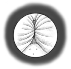 Imagen de una próstata agrandada vista mediante un cistoscopio desde el interior de la uretra.