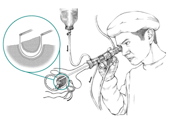 Imagen enseñando el procedimiento conocido como resección transuretral de la próstata (TURP) en la que el medico quita el exceso de tejido de la próstata con un instrumento que tiene un asa eléctrica.
