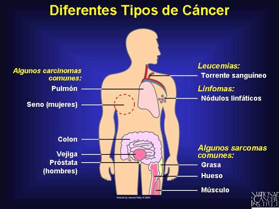 Diferentes Tipos de Cáncer