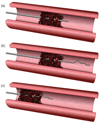 A three-stage drawing of the corkscrew device removing a blood clot..