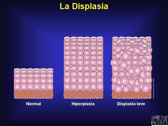 La Displasia