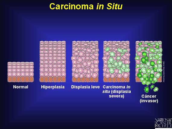 Carcinoma <i>in Situ</i>