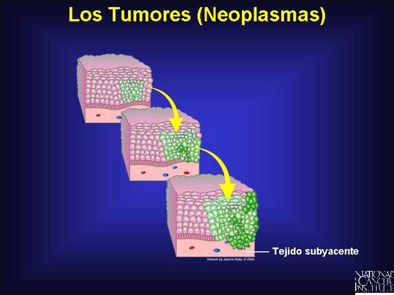 Los Tumores (Neoplasmas)