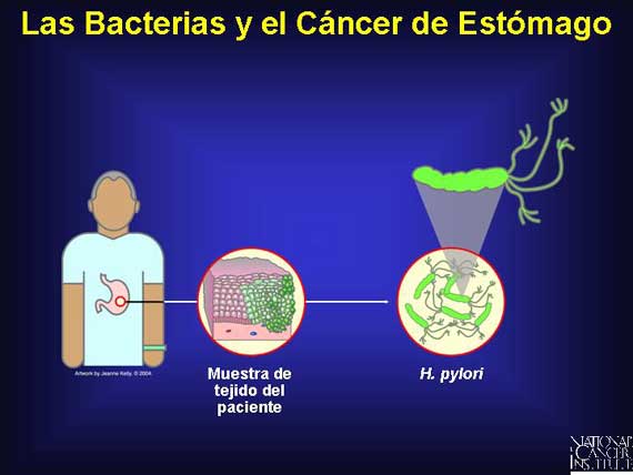 Las Bacterias y el Cáncer de Estómago