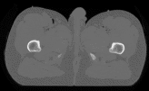 Specimen from the Visible Human Male - Pelvis subset