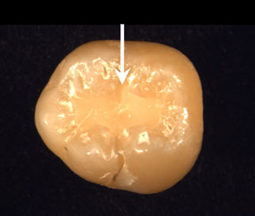 photo of tooth