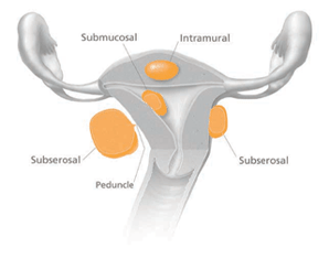 Location of uterine fibroids