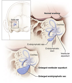 Diagram of normal inner ear and enlarged vestibular aqueduct, showing the cochlea, endolymphatic sac, endolymphatic duct, vestibular aqueduct, enlarged vestibular aqueduct, and enlarged endolymphatic sac.