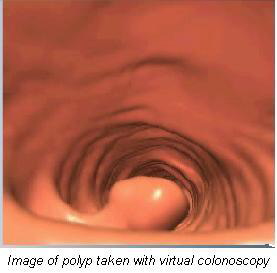 Image of polyp taken with virtual colonoscopy