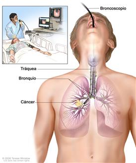 Broncoscopia; el dibujo muestra un broncoscopio insertado a través de la boca, la tráquea y el bronquio, hasta el pulmón; los ganglios linfáticos a lo largo de la tráquea y los bronquios, y el cáncer en un pulmón. El recuadro muestra al paciente acostado sobre una camilla mientras se le realiza la broncoscopia.