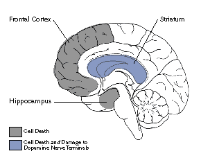 Mouse and Human Brain Damage by Methamphetamine