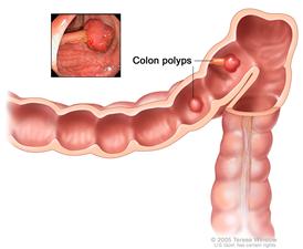 Colon polyps; shows two polyps (one flat and one pedunculated) inside the colon.  Inset shows photo of a pedunculated polyp.