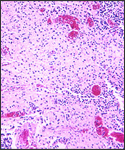Histopathology of the gallbladder in a case of Typhoid fever.