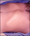 Rose spots on abdomen of a patient with typhoid fever due to the bacterium Salmonella typhi.