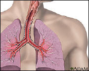 Screen capture of the image from the Asthma Health Topic page