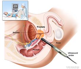 Transrectal ultrasound; drawing shows a side view of the male reproductive and urinary anatomy including the prostate, anus, rectum, and bladder; also shows an  ultrasound probe inserted into the rectum to check the prostate. Inset shows patient lying on back on a  table having a transrectal ultrasound procedure.