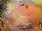 Person with a typical case of shingles - Click to enlarge in new window.