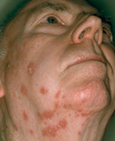 Shingles outbreak on face and neck - Click to enlarge in new window.
