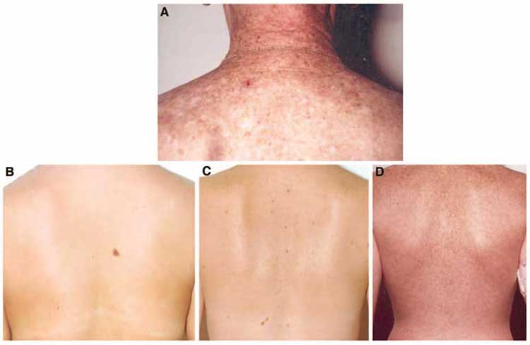 (A) Standard photograph for grading severe solar damage on the shoulders. Standard photographs for grading freckling of the back: (B) mild freckling of the upper back,
one large nevus, four small nevi; (C) moderate freckling of the upper back, four large nevi, 12 small nevi; (D) extensive freckling of the upper and lower back, no nevi.