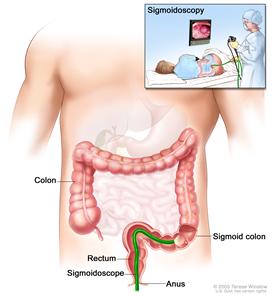 Sigmoidoscopy; shows sigmoidoscope inserted through the anus and rectum and into the sigmoid colon.  Inset shows patient on table having a sigmoidoscopy.