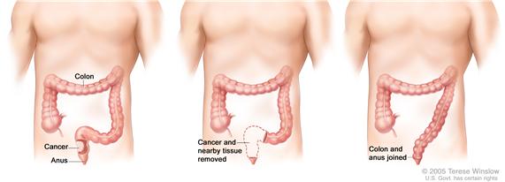 Three-panel drawing showing rectal cancer surgery with anastomosis; first panel shows area of rectum with cancer, middle panel shows cancer and nearby tissue removed, last panel shows the colon and anus joined.