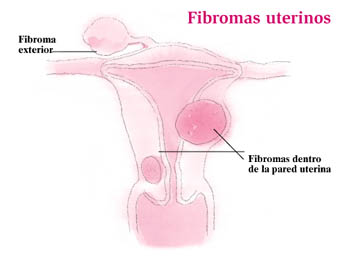 Fibromas Uterinos