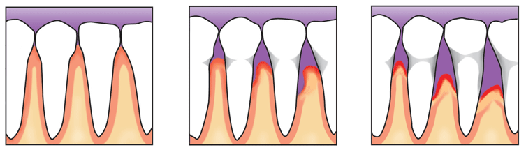 Diagram of normal gums and gums with peridontitis and advanced peridontitis