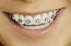 Photograph of a girl's mouth with braces