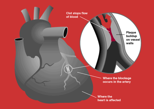 illustration of clot in heart blocking blood flow